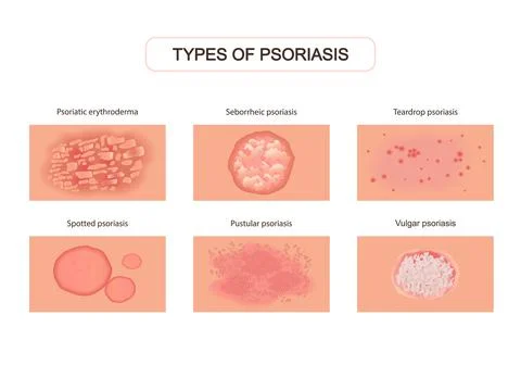 Varieties of psoriasis set. Red eruptions on skin with ulcers and itching damage Stock Illustration