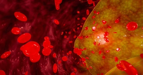 Vascular damage, artery clogging, and plaque buildup from junk food, high sugar  Stock Footage 281767655