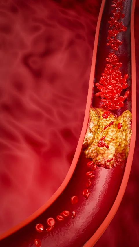 Vascular damage, artery clogging, and plaque buildup from junk food, high sugar  Stock Footage 281767876
