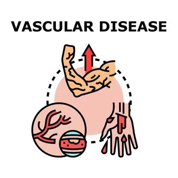 Vascular disease concept comprising artery, vein, injury and blood Stock Illustration