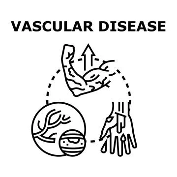 Vascular disease concept comprising artery, vein, injury and blood Stock Illustration