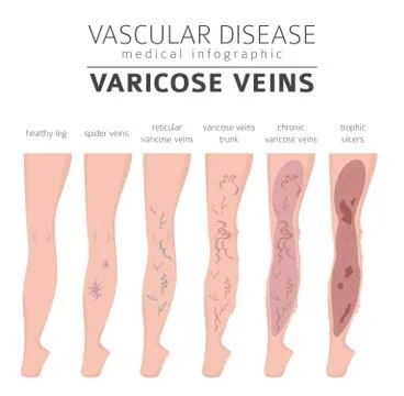 Vascular diseases. Varicose veins symptoms, treatment icon set. Medical infog Stock Illustration