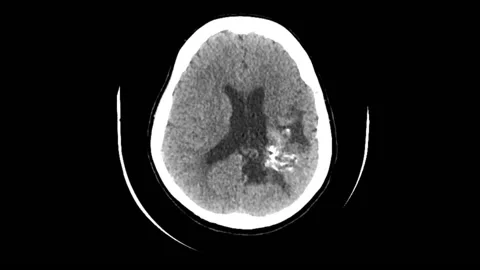 Vascular malformation in the brain, CT scan 스톡 동영상 178664996