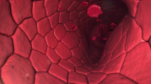Vascular stenosis treated with medication Vídeos de archivo 345011940