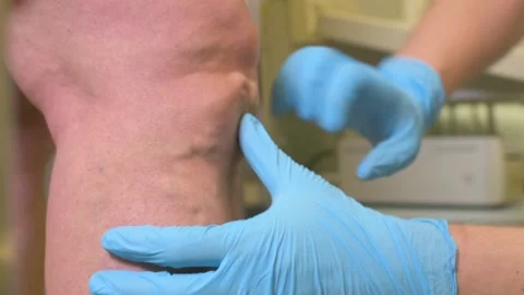 A vascular surgeon or phlebologist makes an ultrasound of varicose veins on the Stock-Footage 152155843