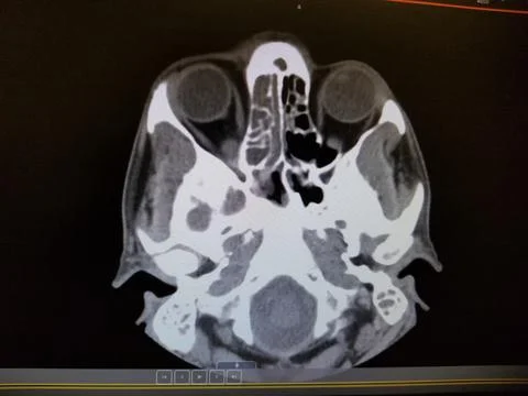 Vasculitis with ethmoid sinusitis - CT Scan of the Sinuses and Face Stock Photos
