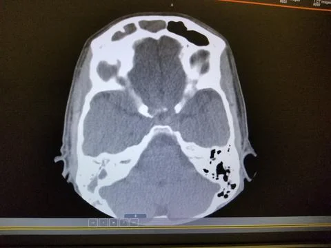 Vasculitis with frontal sinusitis - CT Scan of the Sinuses and brain Stock Photos