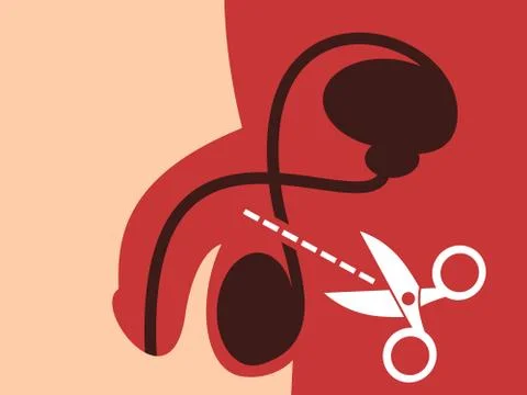 Vasectomy - surgical intervention. Method of birth control and contraception Stock Illustration
