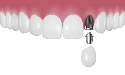 Vector 3d Realistic Render Human Teeth with Implant Closeup Isolated on White Illustrazione stock