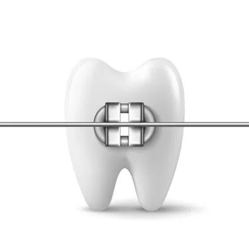 Vector 3d Realistic Tooth with Braces Icon Closeup Isolated on White Background Stock Illustration