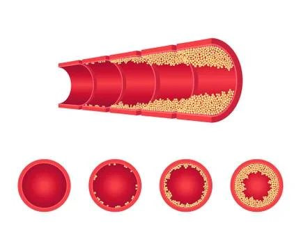 Vector atherosclerosis vein artery throms flat set Stock Illustration