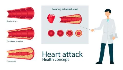 Vector atherosclerosis vein artery throms flat set Stock Illustration
