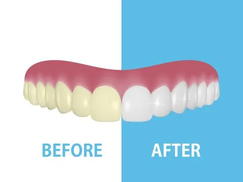 Vector Background with 3d Realistic Render Denture Set Closeup Isolated Stock Illustration