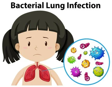 A Vector of Bacterial Lung Infection Stock Illustration