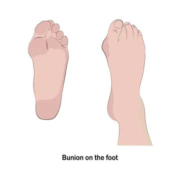 Vector Bunion on the foot. Stock Illustration