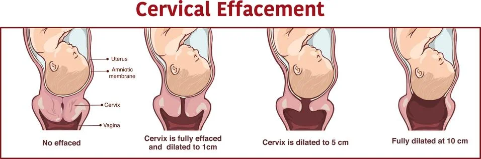 Vector - Cervical effacement and dilatation during labor Stock Illustration