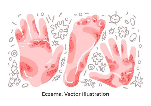 Vector color set Eczema, illness symptom, bacteria and methods of treatment S Stock-Illustration