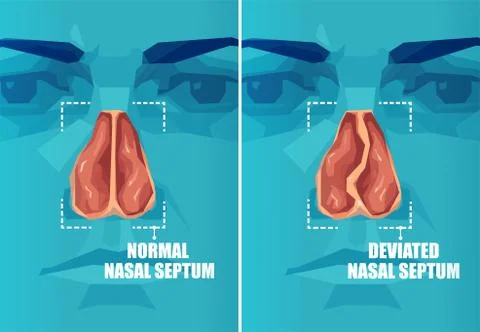 Vector cross section of face with deviated and normal nasal septum Stock Illustration