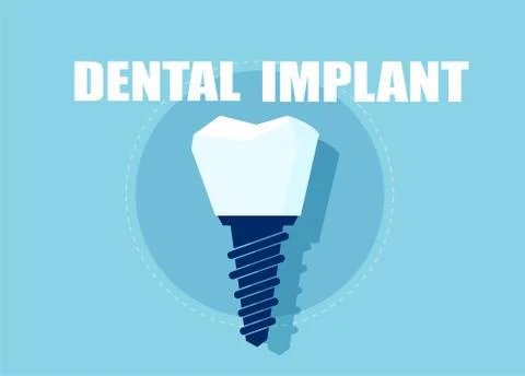 Vector of a dental implant Stock Illustration
