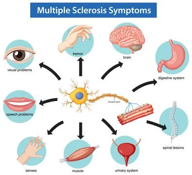 Vector Diagram Illustrating Multiple Sclerosis Symptoms and Effects Stock Illustration