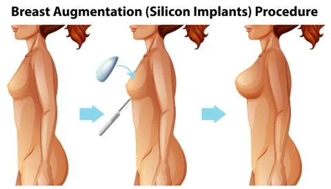 A Vector of Female Breast Implants Stock Illustration