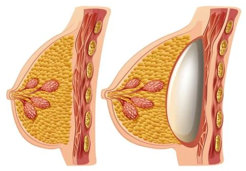 A Vector of Female Breast Implants Stock Illustration