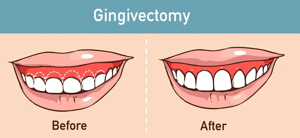 Vector illstration of a Gingivectomy Stock Illustration