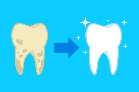 Vector illstration of teeth cleaning concept. Flat design. Isolated. Stock Illustration