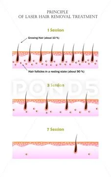 Vector illustarion that shows why it is impossible to remove all unwanted hair Stock Illustration