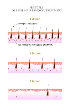 Vector illustarion that shows why it is impossible to remove all unwanted hair Illustrazione stock