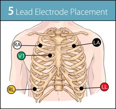 Vector illustration of a 5 lead electrode placement Stock Illustration