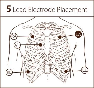 Vector illustration of a 5 lead electrode placement Stock Illustration