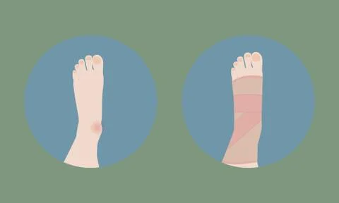 Vector illustration of ankle sprain and foot in brace Illustrazione stock