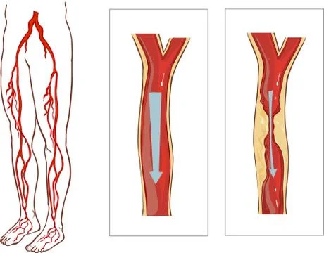 Vector illustration of aVascular System Legs. Atherosclerosis in artery Stock Illustration