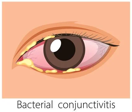 Vector Illustration of Bacterial Conjunctivitis in Human Eye Stock Illustration