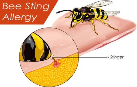 Vector illustration of a Bee sting allergy Stock Illustration
