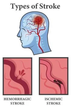 Vector illustration of Brain Stroke Types. Ischemic and Hemorrhagic types pos Stock Illustration
