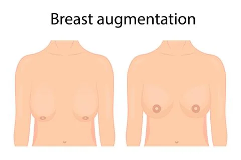 Vector illustration of breast plastic surgery. before and after. Stock Illustration