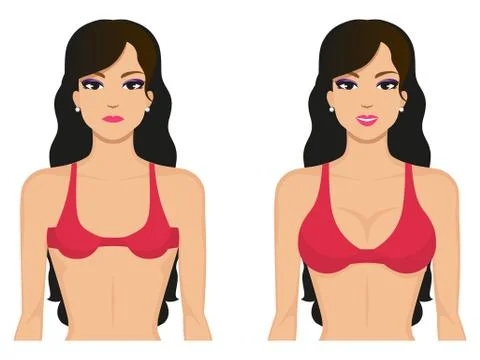 Vector illustration breasts before and after Stock Illustration
