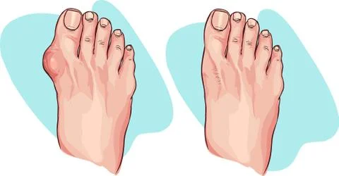 Vector illustration of bunion before and after operation Stock Illustration