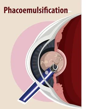 Vector illustration of  Cataract surgery Stock Illustration