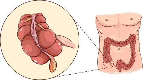 Vector illustration of a with detail of an appendicitis Stock Illustration
