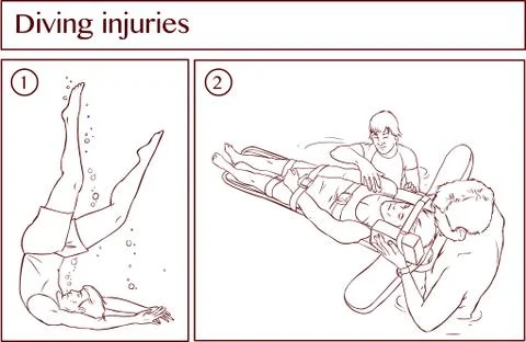 Vector illustration of a Diving injuries Stock Illustration