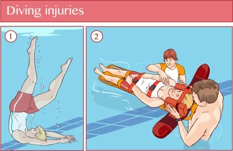 Vector illustration of a Diving injuries Stock Illustration