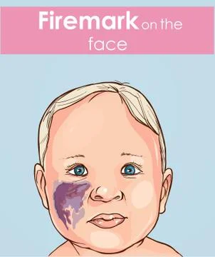 Vector illustration of a firemark on the  baby face. Stock Illustration