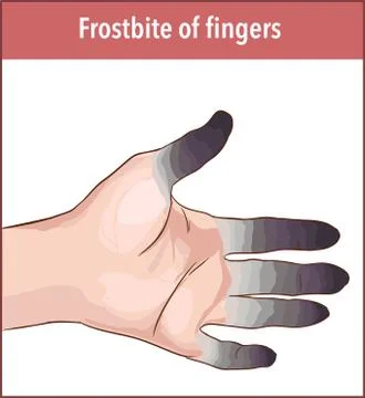 Vector illustration of a frostbite finger Stock Illustration