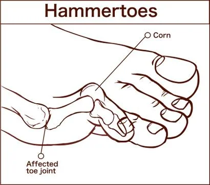 Vector illustration of a hammertoes . Stock Illustration