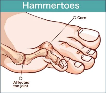 Vector illustration of a hammertoes . Stock Illustration