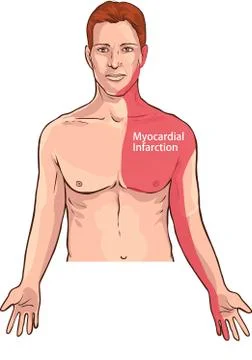 Vector illustration of a Heart attack pain location (Myocardial Infarction) Stock Illustration
