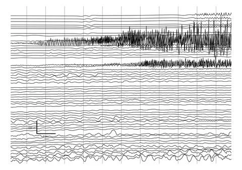 Vector Illustration of ictal EEG recording during seizure. Stock Illustration